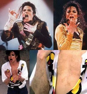 vitiligo-mj-hands.jpg