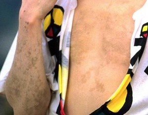 MichaelJacksonVvitiligo-3.jpg